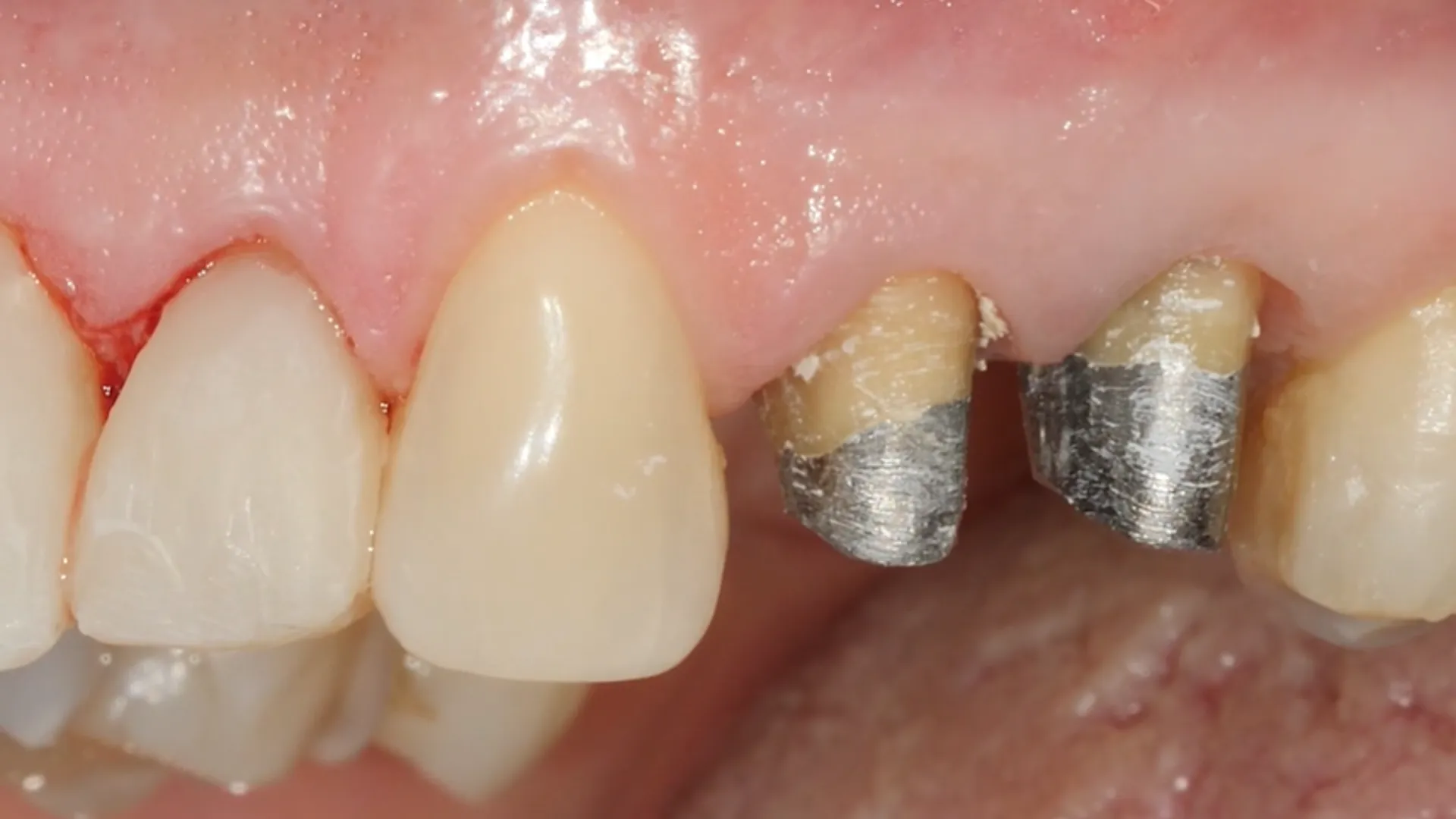 What Does Too-Open Vertical Mean in Dental Terms?