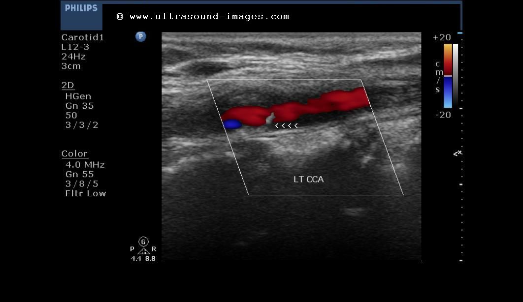 What Does CCA Mean in a Carotid Ultrasound?