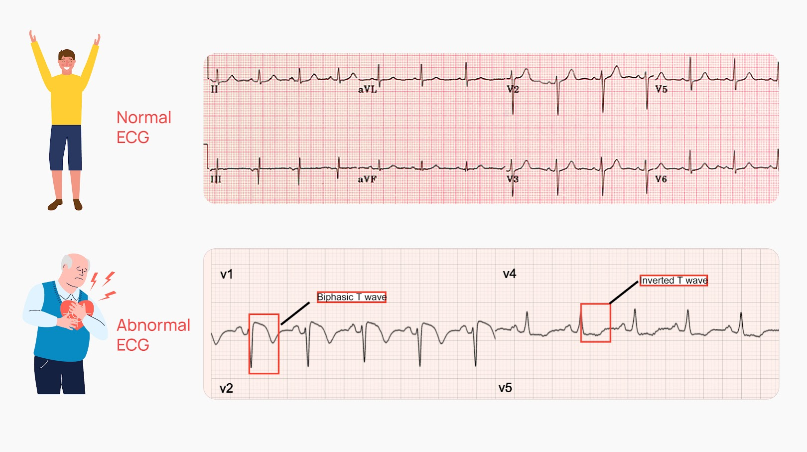 What Does an Abnormal ECG Mean? Heart Test Results Explained