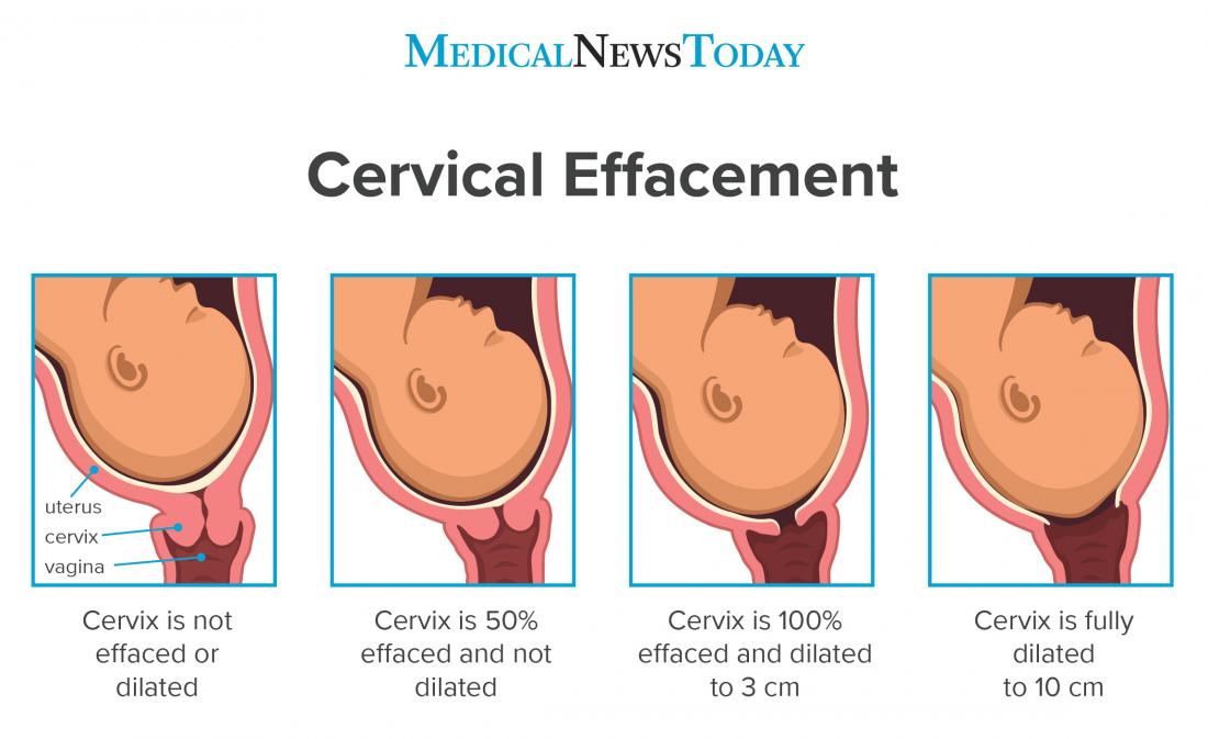 What Does -2 Station Mean When Checking the Cervix? Labor Explained