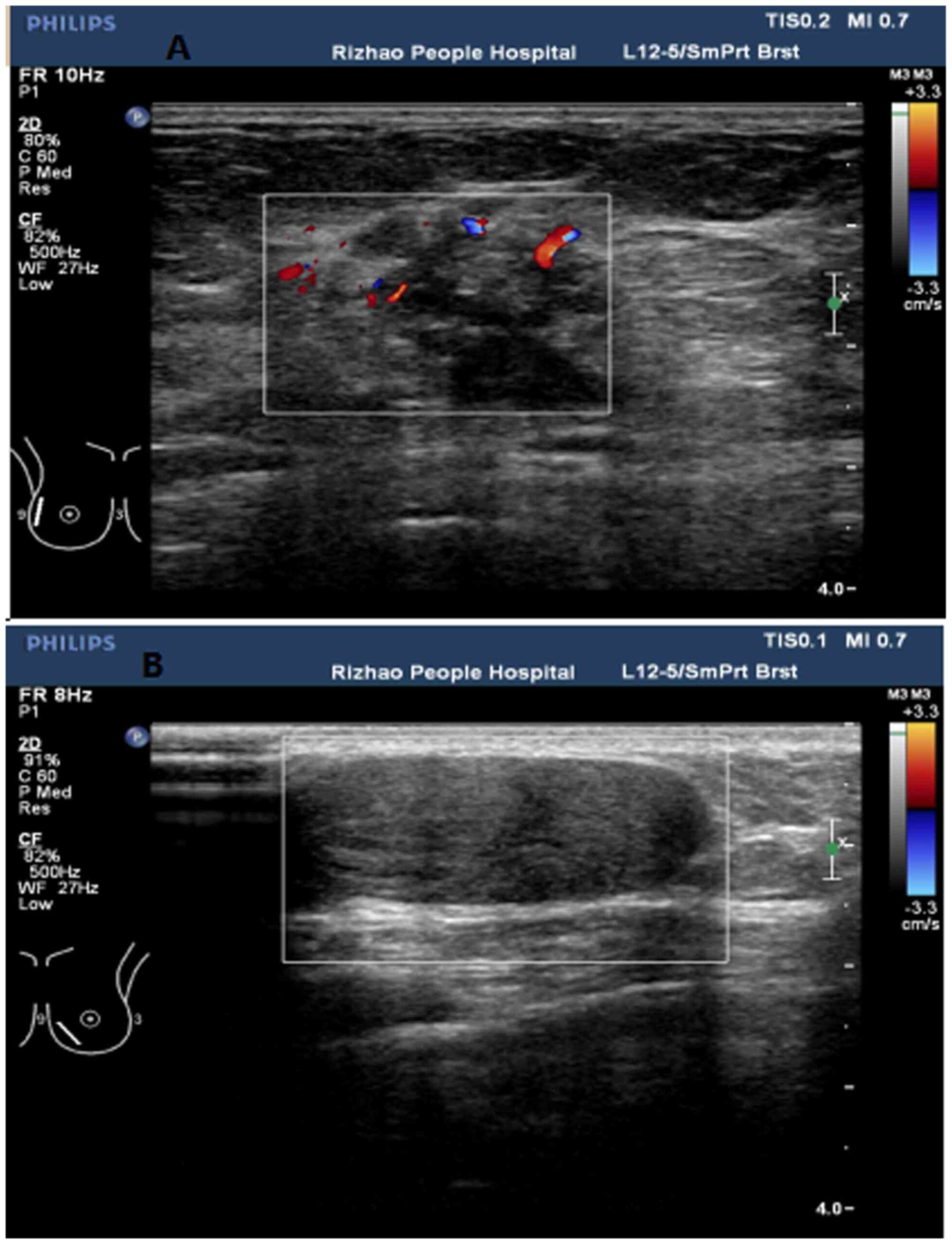 What Do Colors Mean on an Ultrasound? Imaging Guide